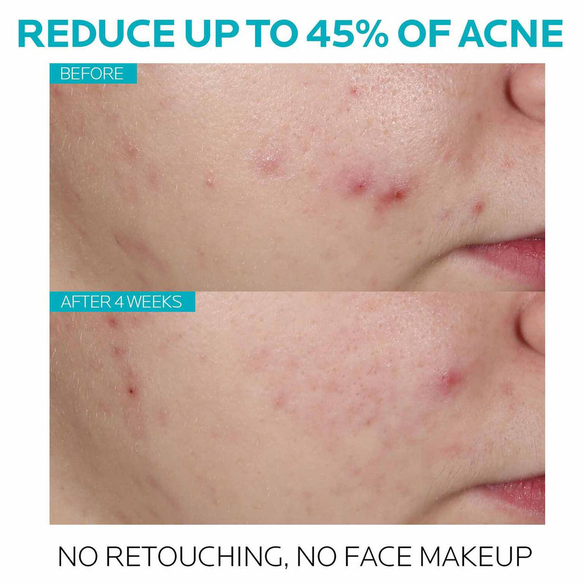 effaclar-salicylic-acid-acne-treatment-serum-m4 7_EffaclarSerum_After-45-days.jpg
