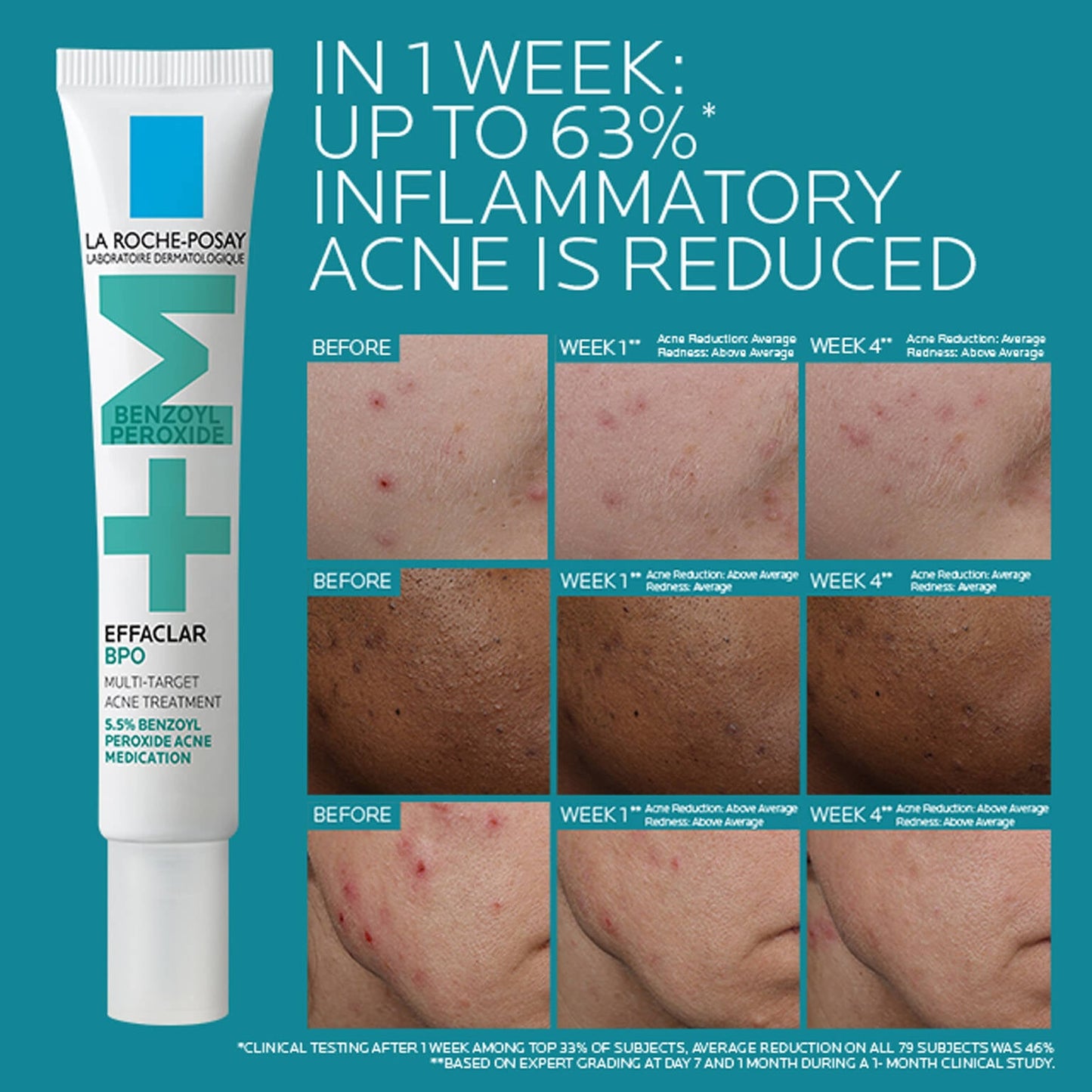 effaclar-bpo-multi-target-acne-treatment-with-5-5-benzoyl-peroxide-z1 EffaclarBPO-ClinicalBA-ATF-1500x1500-2.jpg