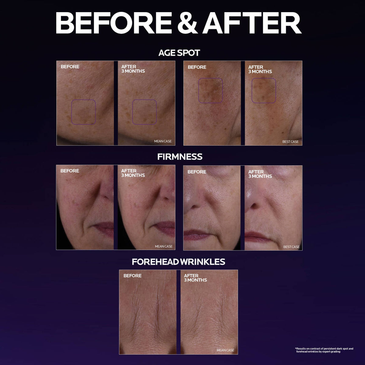 mela-b3-double-dose-discoloration-treatment-with-melasyltm-c7 MelaB3_DD_BTF_BeforeAfter_1500x1500_5.jpg