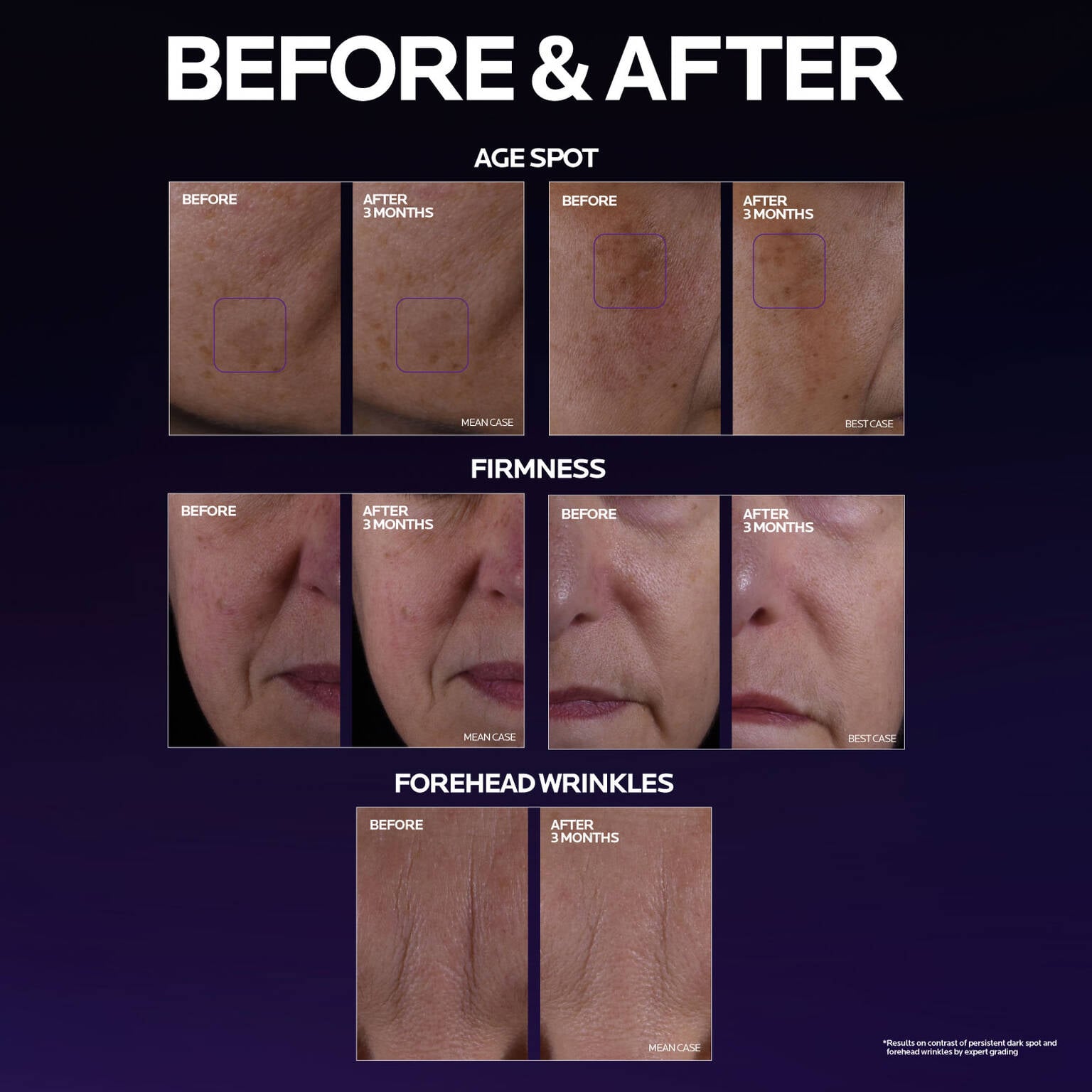 mela-b3-double-dose-discoloration-treatment-with-melasyltm-c7 MelaB3_DD_BTF_BeforeAfter_1500x1500_5.jpg